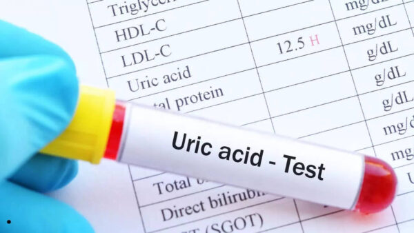 Uric Acid Test