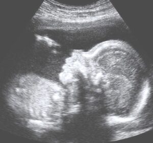 Anomaly scan in pregnancy