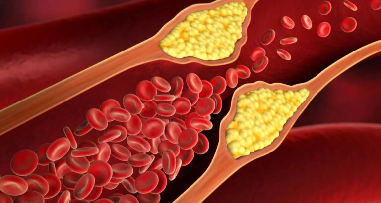 Why would I need a Lipid blood test?