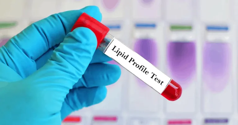 All You Need To Know About Lipid Profile Test Pune