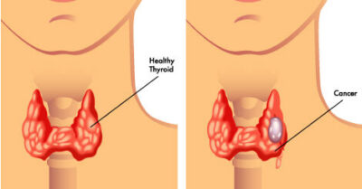 Thyroid Test Sunrise Diagnostic Centre