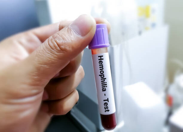 hemoglobin test