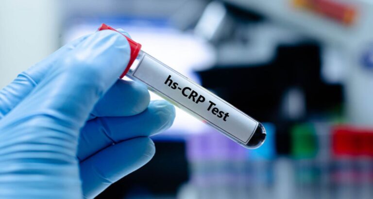 CRP Blood Test in Pune: Accurate Inflammation Detection at Sunrise Diagnostic Centre Pune