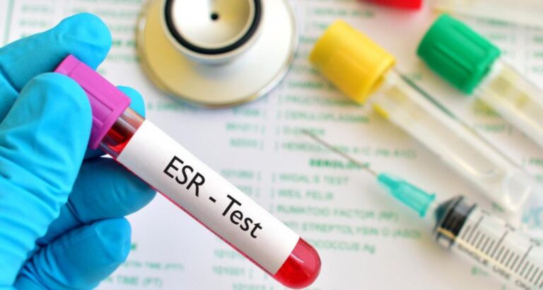 ESR Blood Test -Normal Values, Cost & Preparation