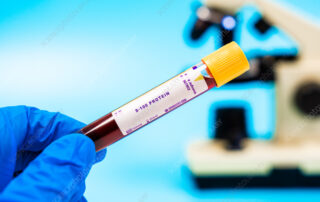 Protein Blood Test