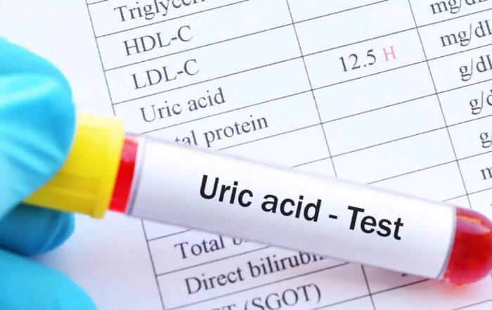 Uric Acid Test